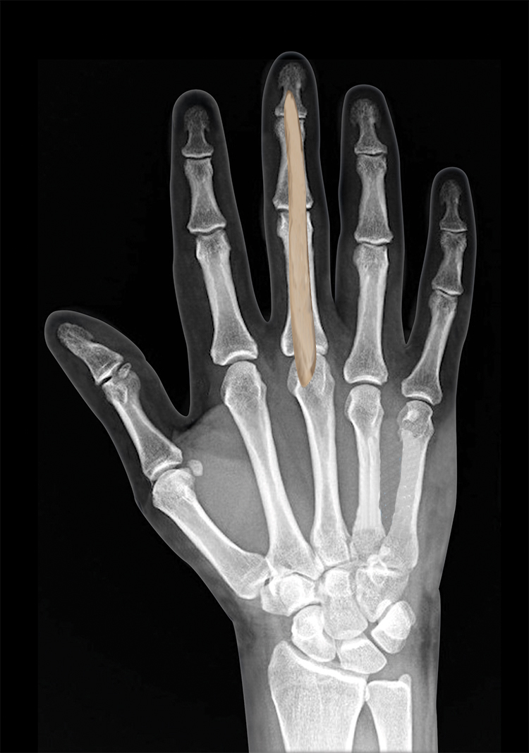 INFECTION FLEXOR TENDON SHEATH Hand Surgery Resource infection-flexor-tendon-sheath-hand-surgery-resource
